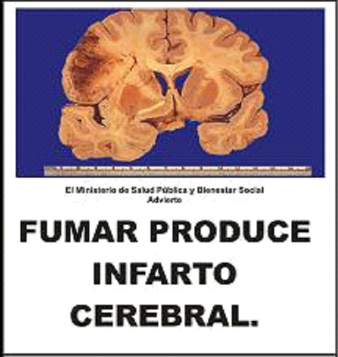 Paraguay 2009 Health Effects Stroke - Cerebral Infarction, brain scan
